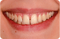 Alessias Lächeln im Detail, vor und nach der Anwendung von Veneers.