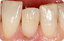 Internes Zahnbleichen für devitalisierte Zähne