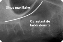 os restant très réduit et la présence du sinus maxillaire