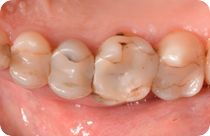 Alte und infiltrierte Zahnfüllungen aus Composite