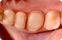 reconstruction directe de la partie centrale des dents