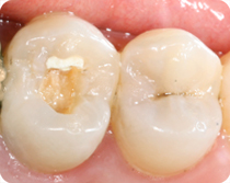 dévitalisation du dent