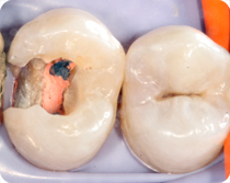 Interne Reinigung des Zahns und seine Füllung