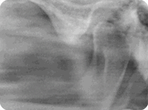 Röntgenaufnahme eines gemeinsamen (TMJ) links