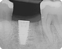radiographie implant titane ostéo-intégré